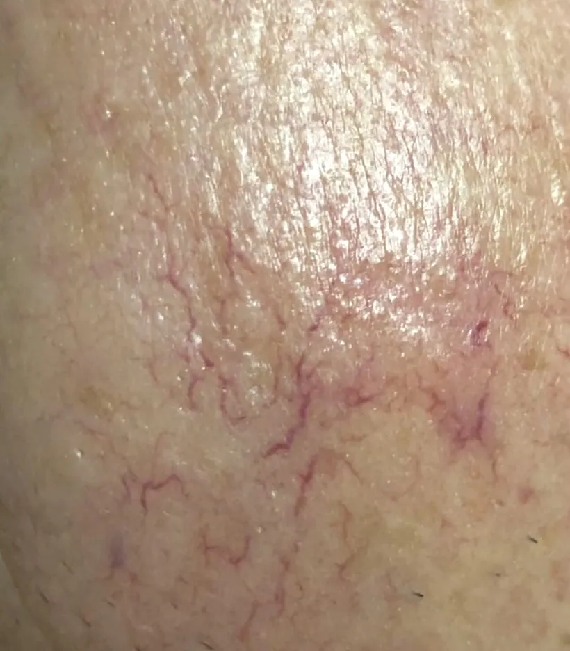 Couperose mit sichtbaren roten Äderchen